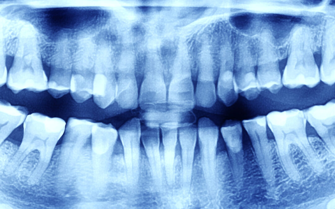 X-ray,Of,The,Oral,Cavity,With,Teeth.,Orthopantomogram.,Toned