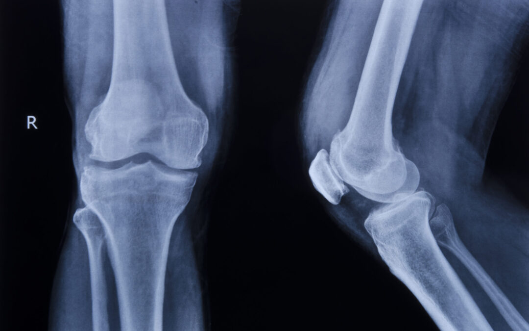 Collection,Of,X-ray,Normal,Knee