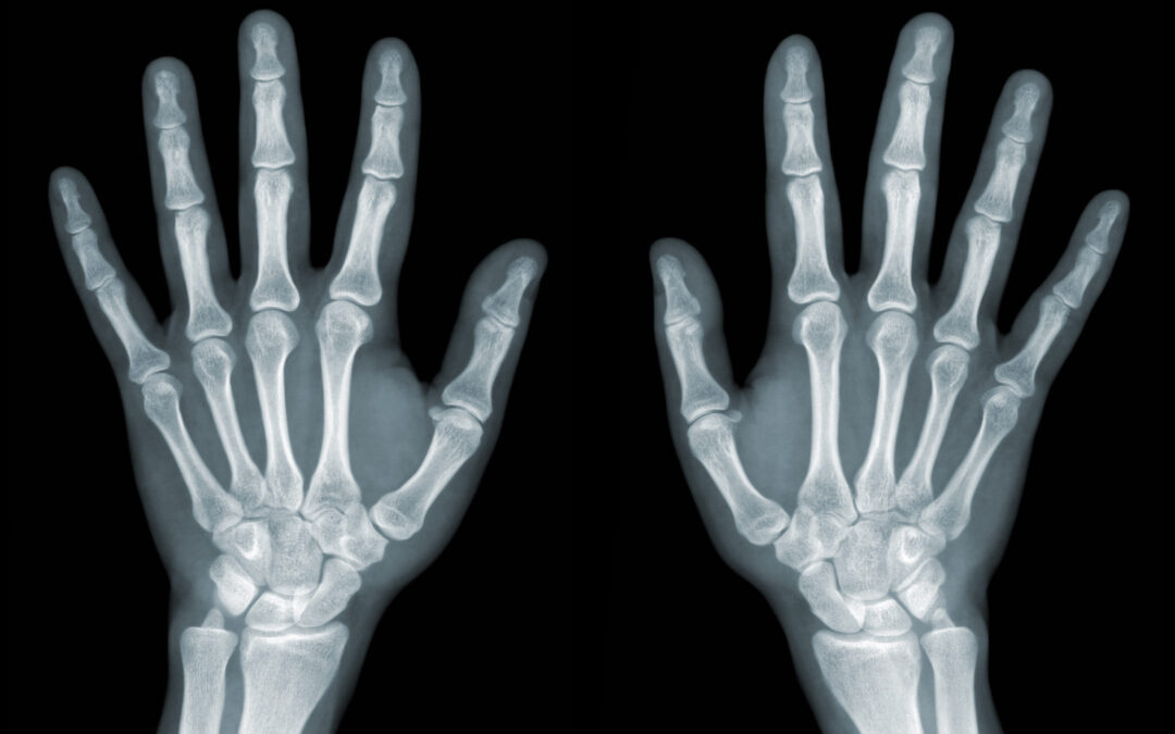 X-ray,Of,The,Hands,On,Black,Background