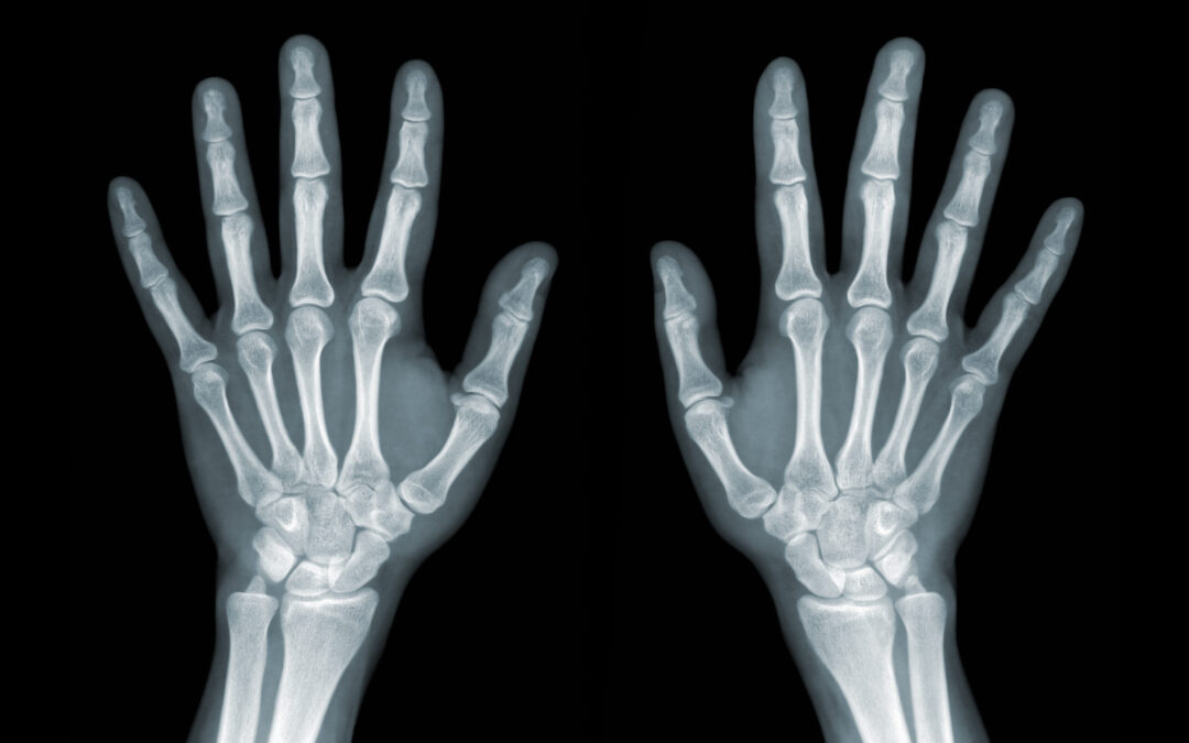 X-ray,Of,The,Hands,On,Black,Background
